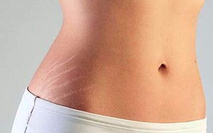 Kako smanjiti strije i spriječiti njihov nastanak